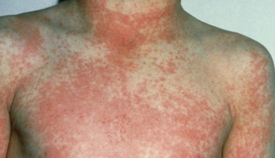 Photograph of Parents encouraged to be aware of scarlet fever symptoms