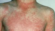 Thumbnail for article : Parents encouraged to be aware of scarlet fever symptoms